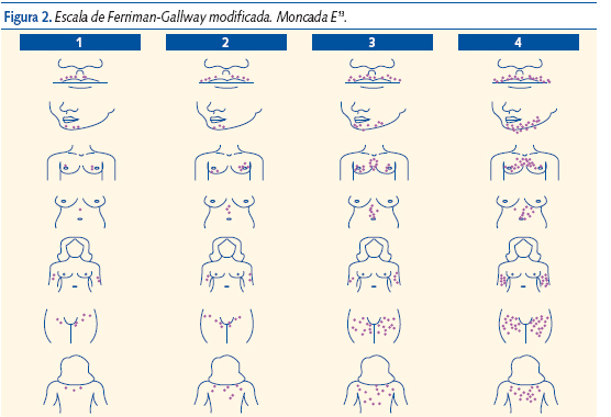 Figura 2. Escala de Ferriman-Gallway modificada. Moncada E13.